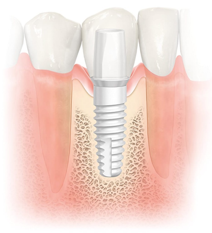 Dental implant treatment options