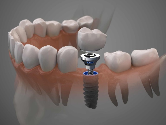 Dental Implants